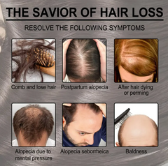 Rosemary Anti-loss Hair Growth